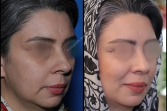 nose-surgery-0026
