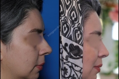 nose-surgery-0027