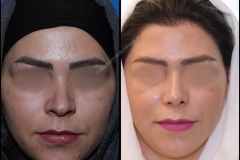 nose-surgery-0028