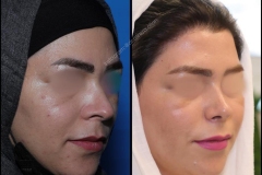 nose-surgery-0029