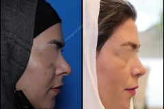 nose-surgery-0030