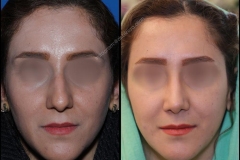 nose-surgery-0031