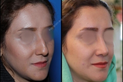 nose-surgery-0032