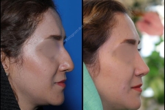 nose-surgery-0033