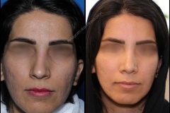 nose-surgery-0034