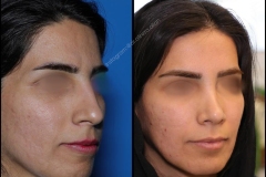 nose-surgery-0035