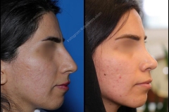 nose-surgery-0036