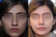 nose-surgery-0037