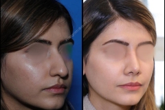 nose-surgery-0038