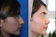nose-surgery-0039
