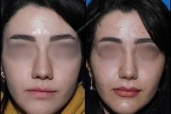 nose-surgery-0040