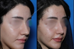 nose-surgery-0041