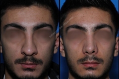 nose-surgery-0043