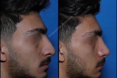 nose-surgery-0045