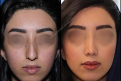 nose-surgery-0046