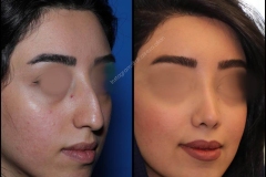 nose-surgery-0047