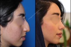 nose-surgery-0048