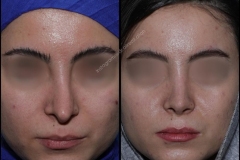 nose-surgery-0049
