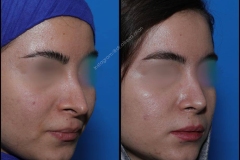 nose-surgery-0050