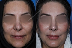 nose-surgery-0052