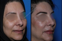 nose-surgery-0053