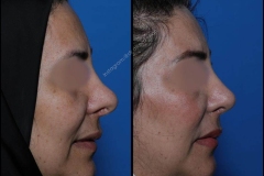 nose-surgery-0054