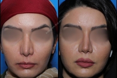 nose-surgery-0055