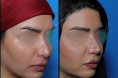 nose-surgery-0056