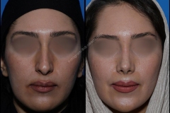 nose-surgery-0058