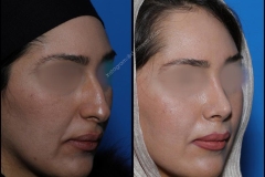 nose-surgery-0059