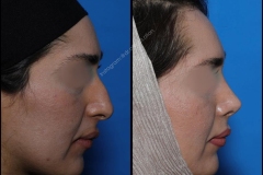 nose-surgery-0060