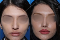 nose-surgery-0061