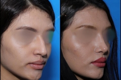 nose-surgery-0062