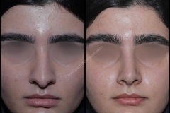 nose-surgery-0064
