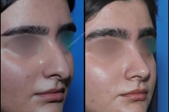 nose-surgery-0065