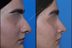 nose-surgery-0066