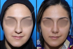 nose-surgery-0067