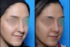 nose-surgery-0068