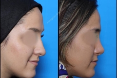 nose-surgery-0069