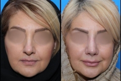 nose-surgery-0070