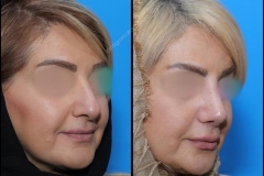 nose-surgery-0071