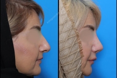 nose-surgery-0072