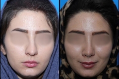 nose-surgery-0073