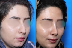 nose-surgery-0074
