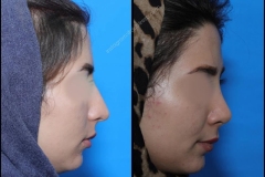 nose-surgery-0075