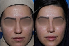 nose-surgery-0076