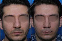 nose-surgery-0077