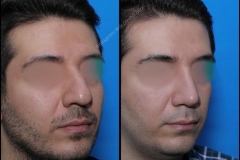 nose-surgery-0078