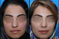 nose-surgery-0080