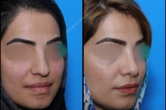 nose-surgery-0081